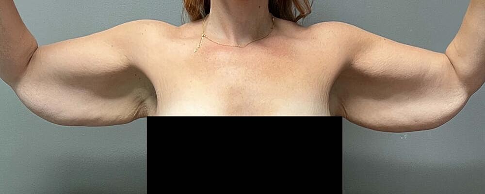 Arm Lift Before & After