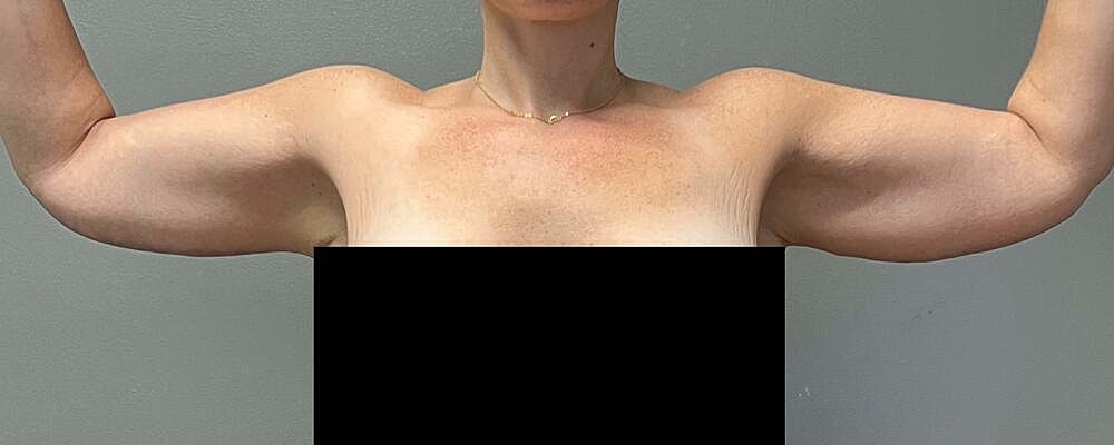 Arm Lift Before & After