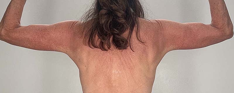 Arm Lift Before & After