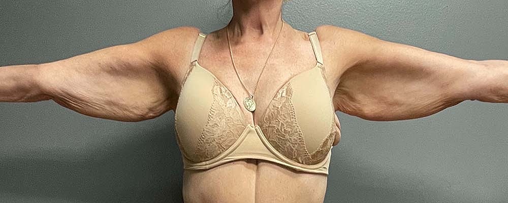 Arm Lift Before & After