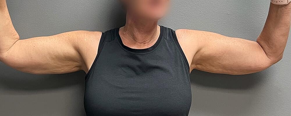 Arm Lift Before & After