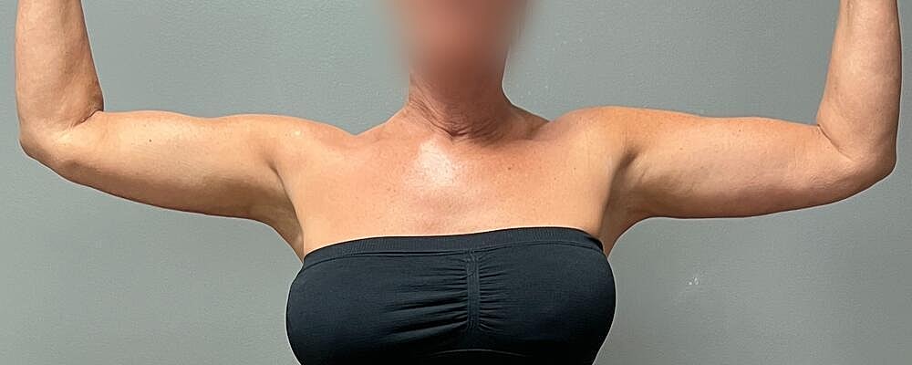 Arm Lift Before & After