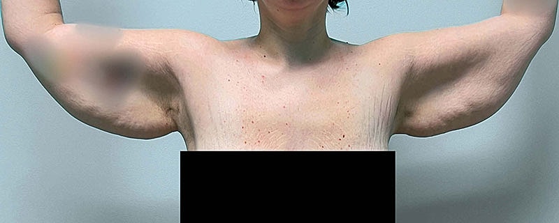 Arm Lift Before & After
