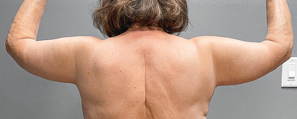Arm Lift Before & After