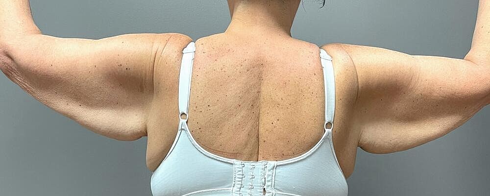 Arm Lift Before & After