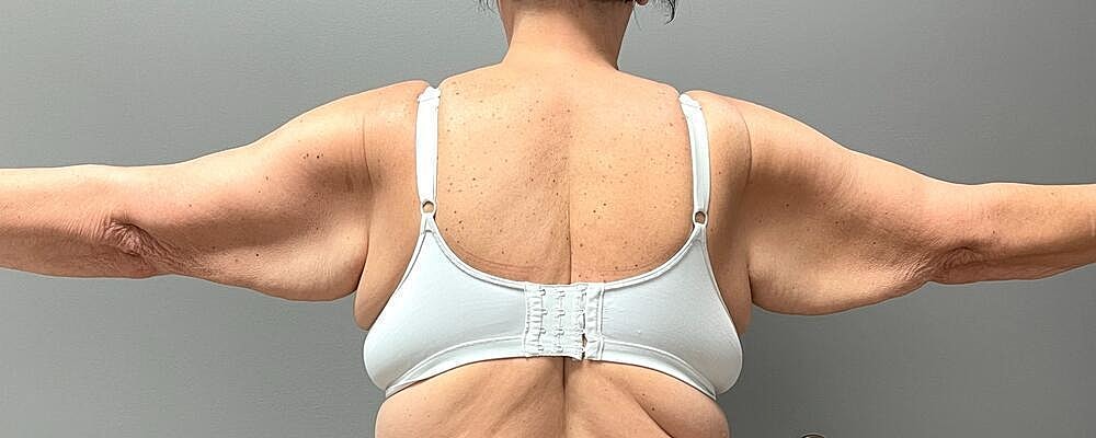 Arm Lift Before & After