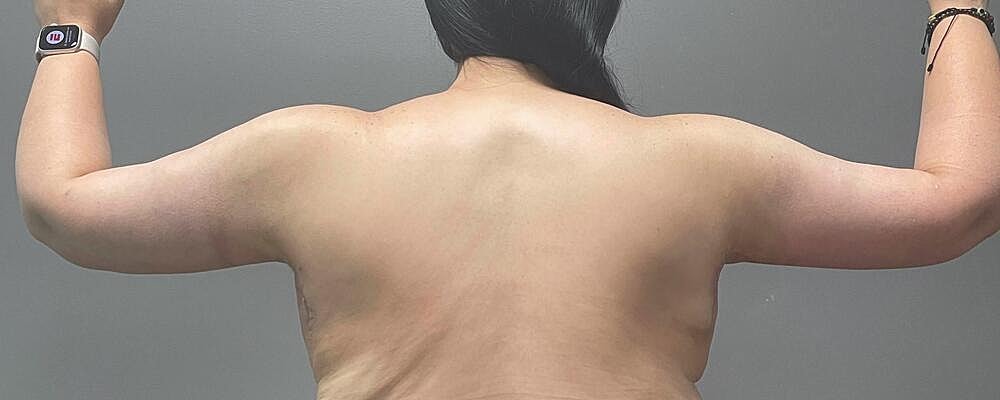 Arm Lift Before & After