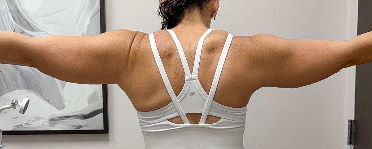 Arm Lift Gallery Before & After