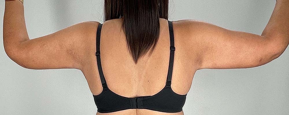 Arm Lift Before & After