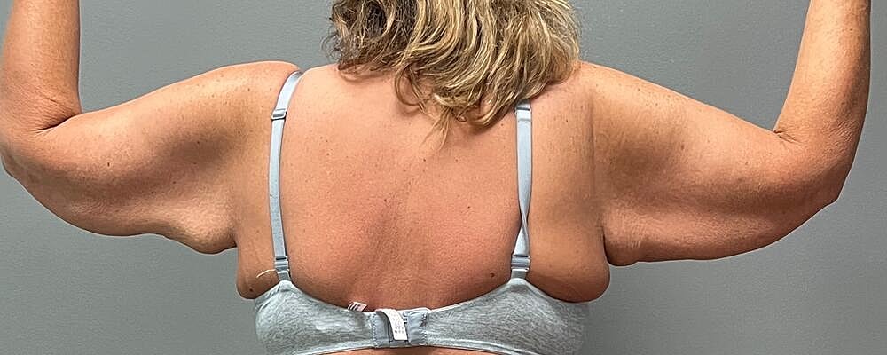 Arm Lift Before & After