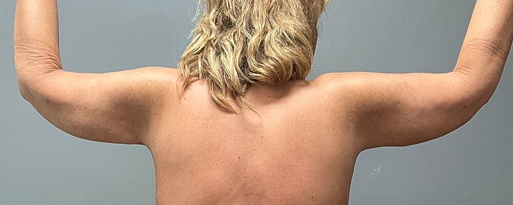 Arm Lift Before & After