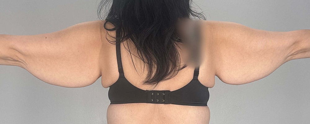 Arm Lift Before & After