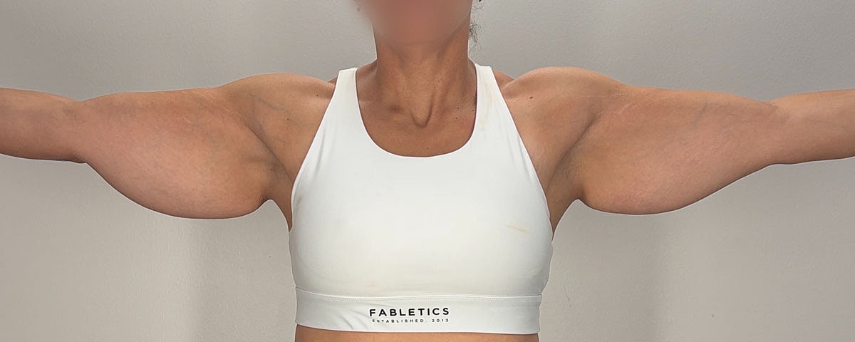 Arm Lift Gallery Before & After