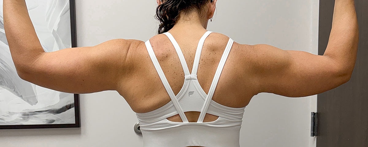 Arm Lift Gallery Before & After