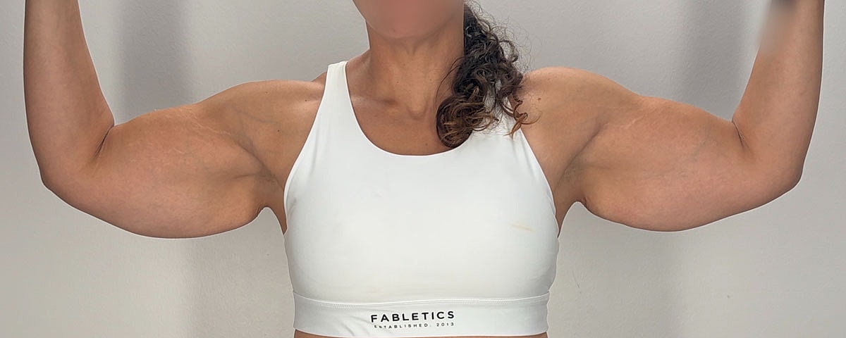 Arm Lift Gallery Before & After