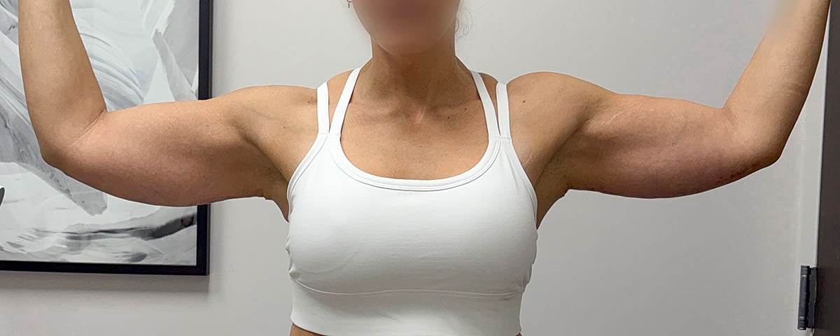 Arm Lift Gallery Before & After