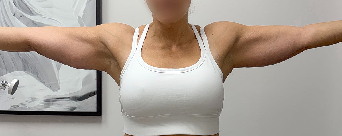 Arm Lift Gallery Before & After