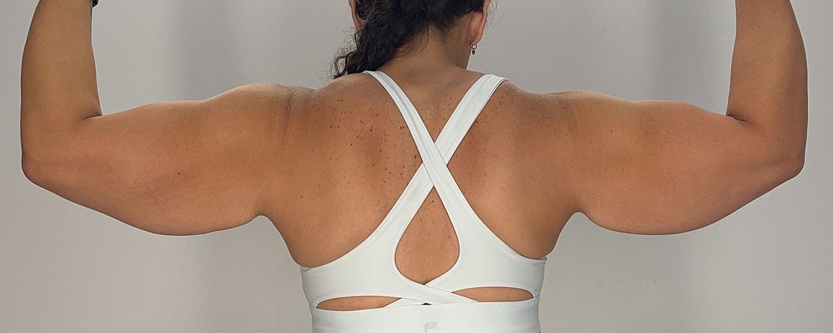 Arm Lift Gallery Before & After