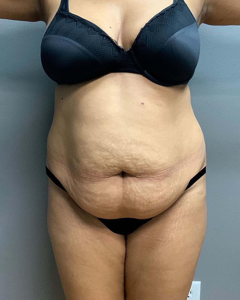 Tummy Tuck Before & After