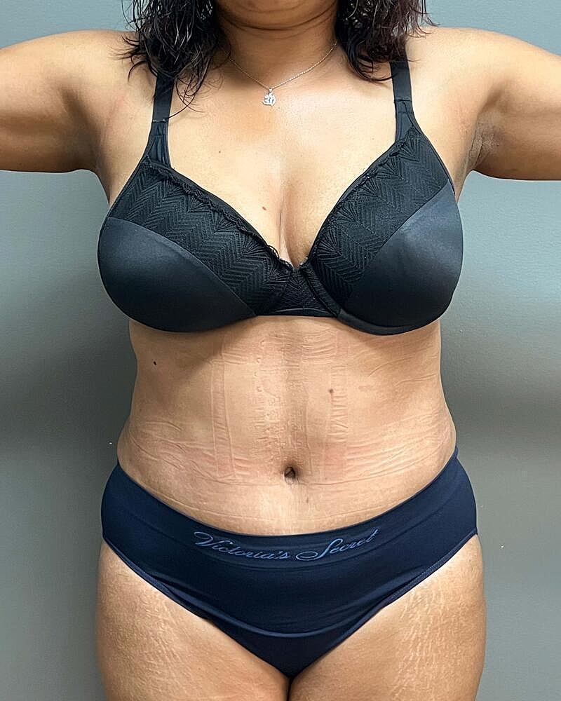 Tummy Tuck Before & After