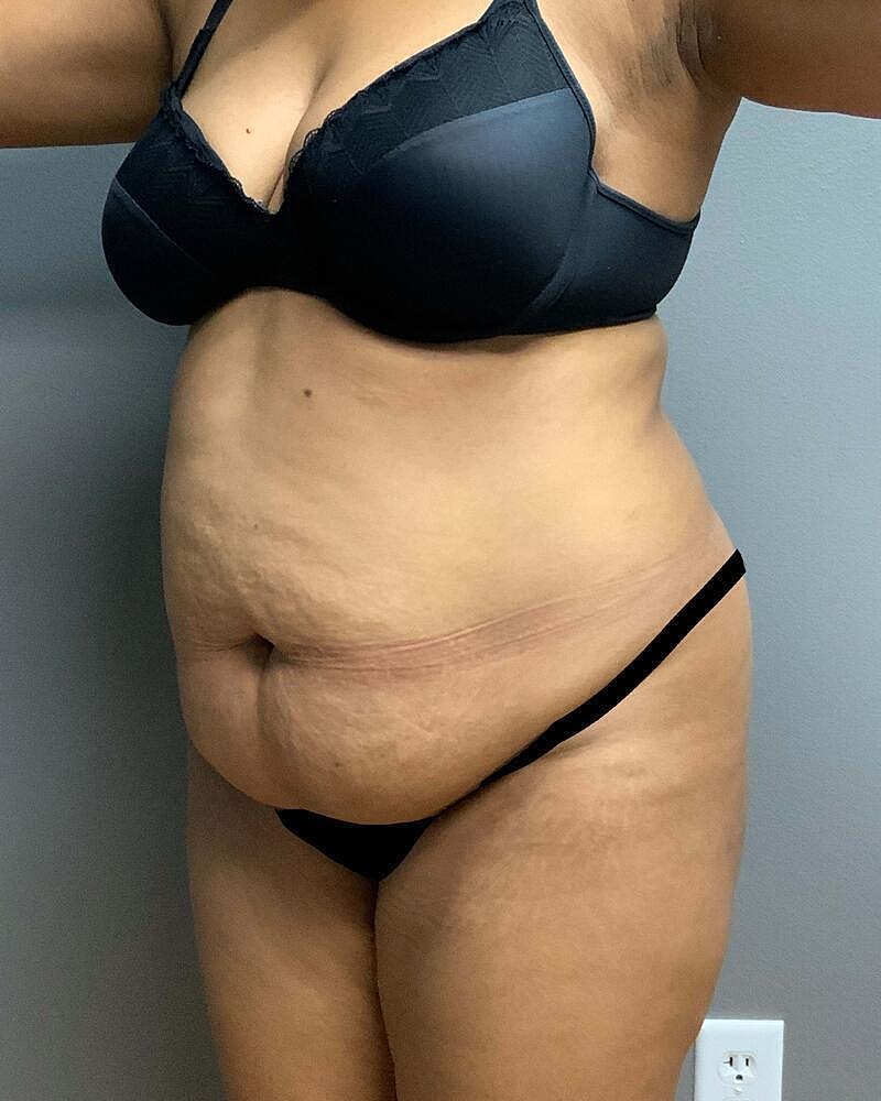 Tummy Tuck Before & After