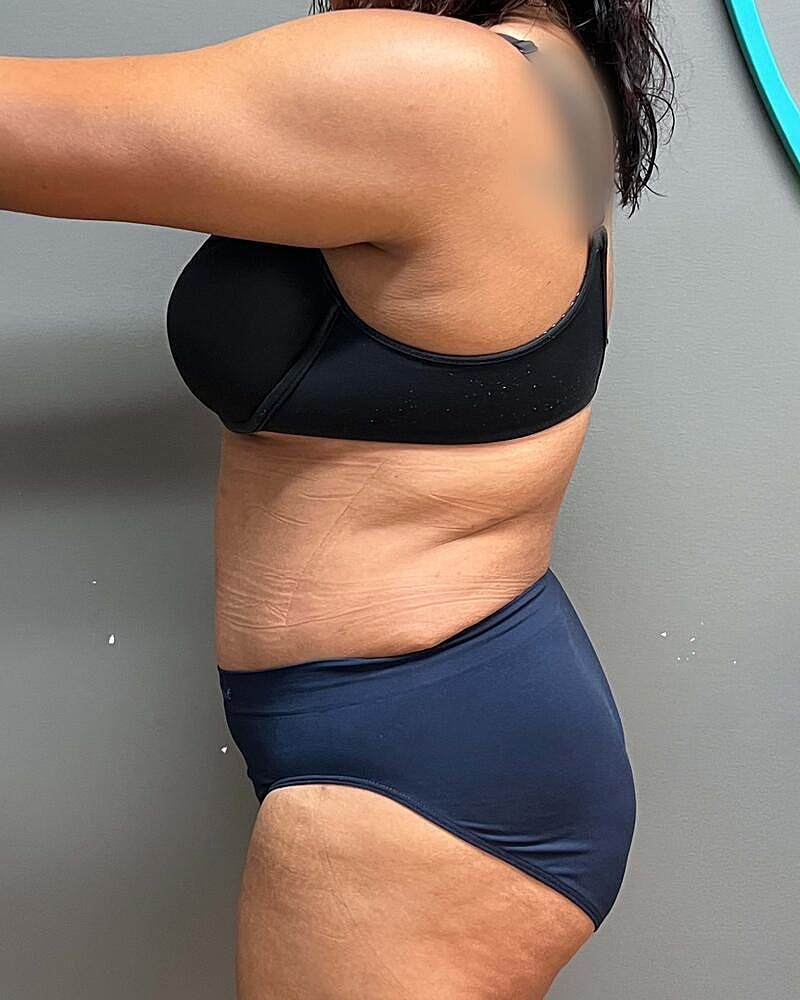 Tummy Tuck Before & After