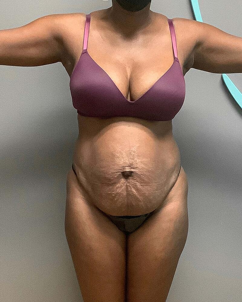 Tummy Tuck Before & After
