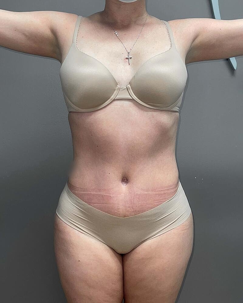 Tummy Tuck Before & After