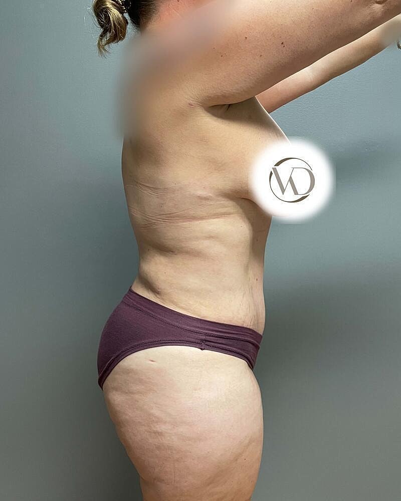 Tummy Tuck Before & After