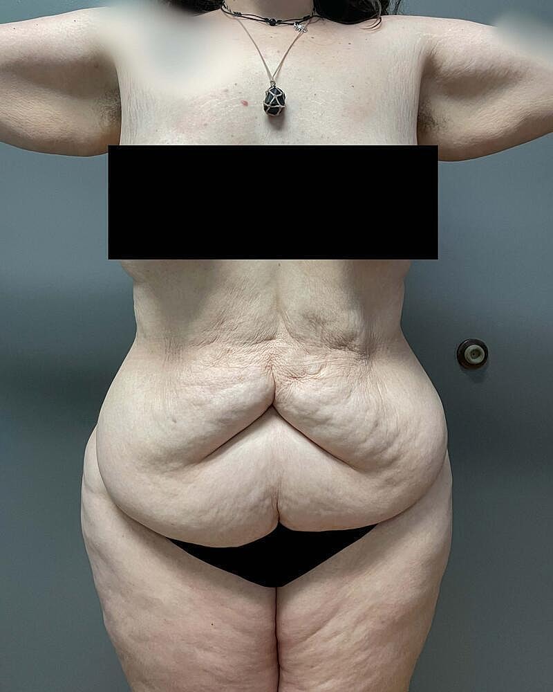 Tummy Tuck Before & After