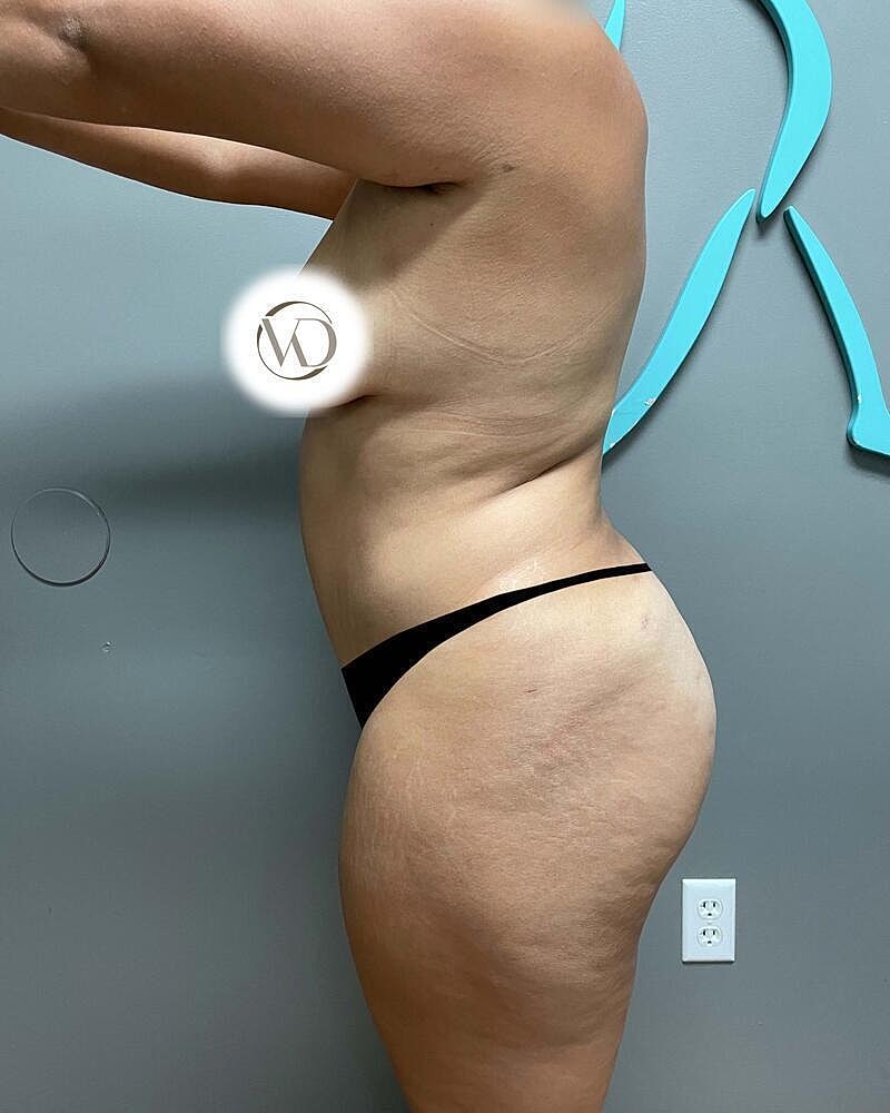 Tummy Tuck Before & After