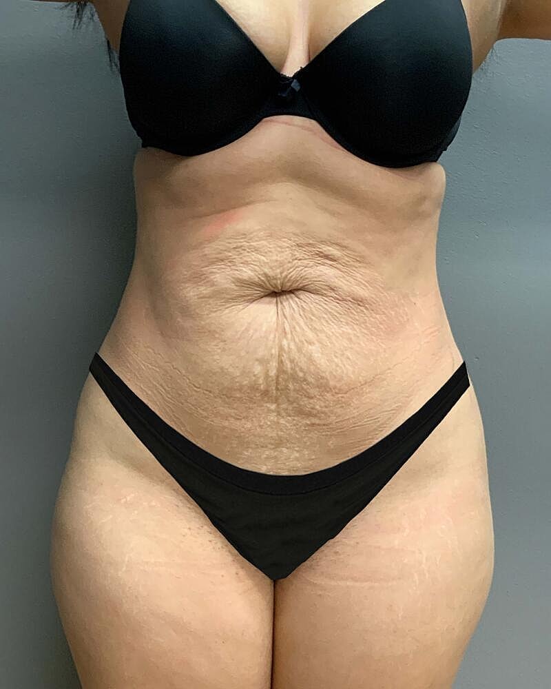 Tummy Tuck Before & After