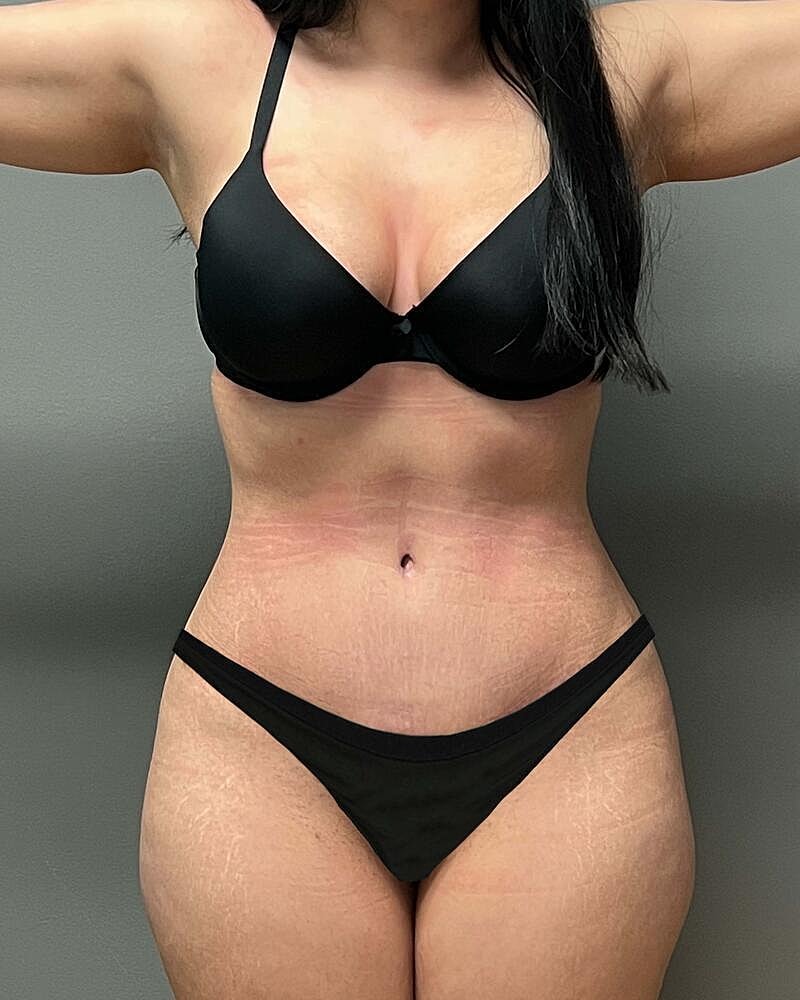 Tummy Tuck Before & After