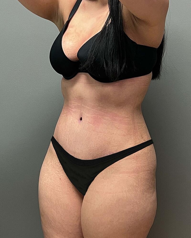 Tummy Tuck Before & After
