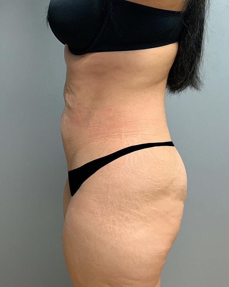 Tummy Tuck Before & After