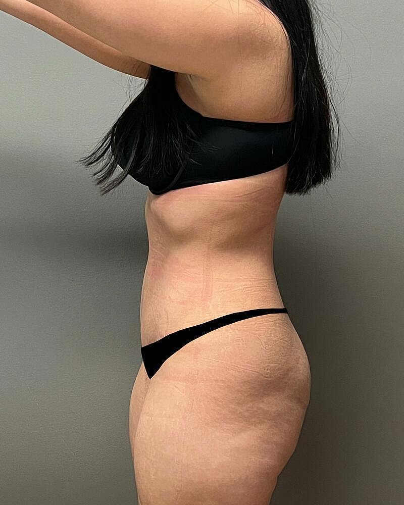 Tummy Tuck Before & After