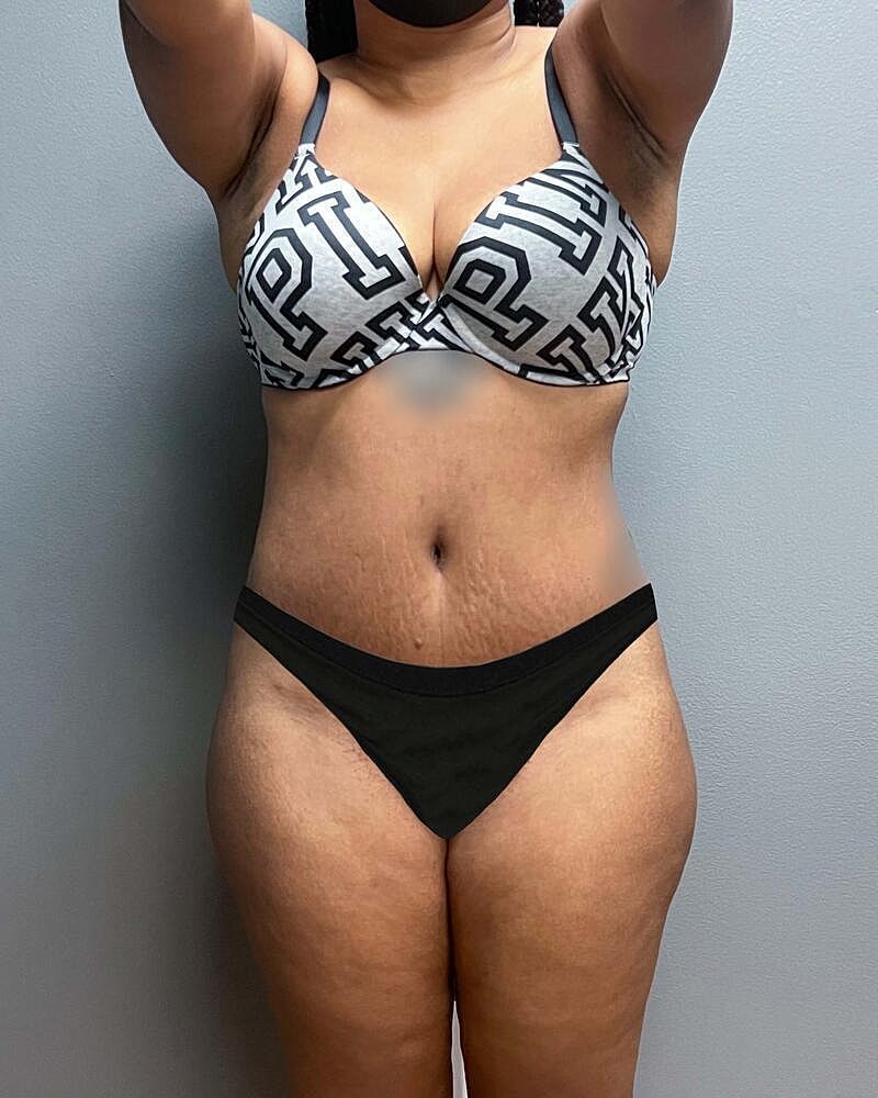 Tummy Tuck Before & After
