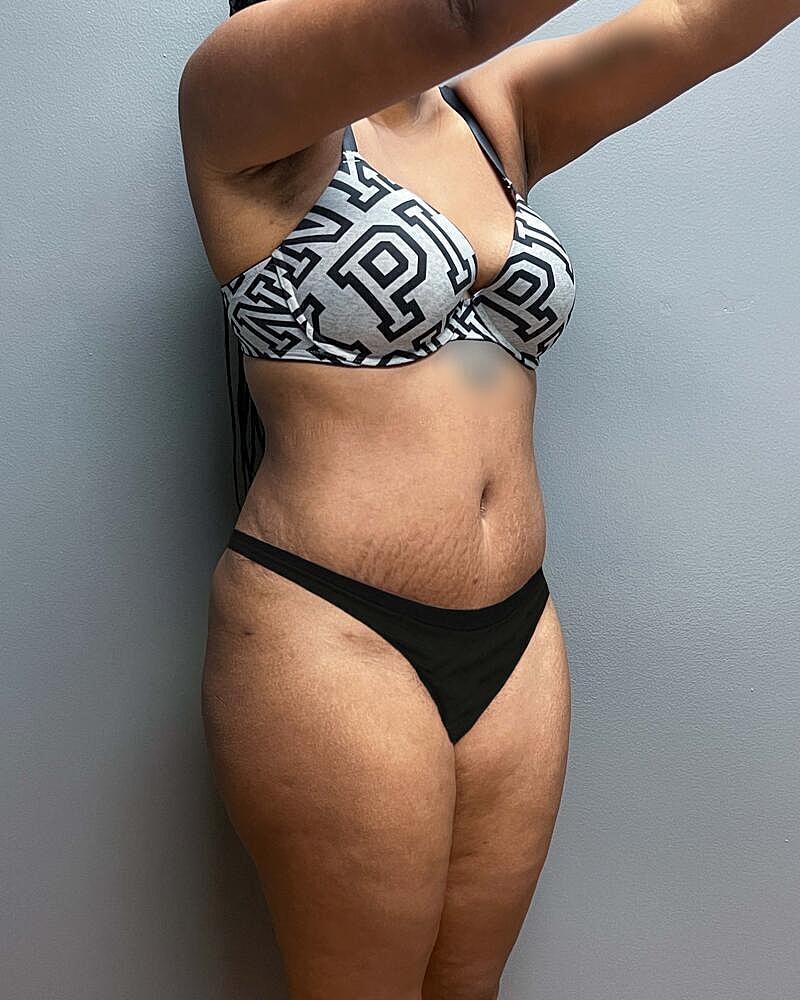 Tummy Tuck Before & After