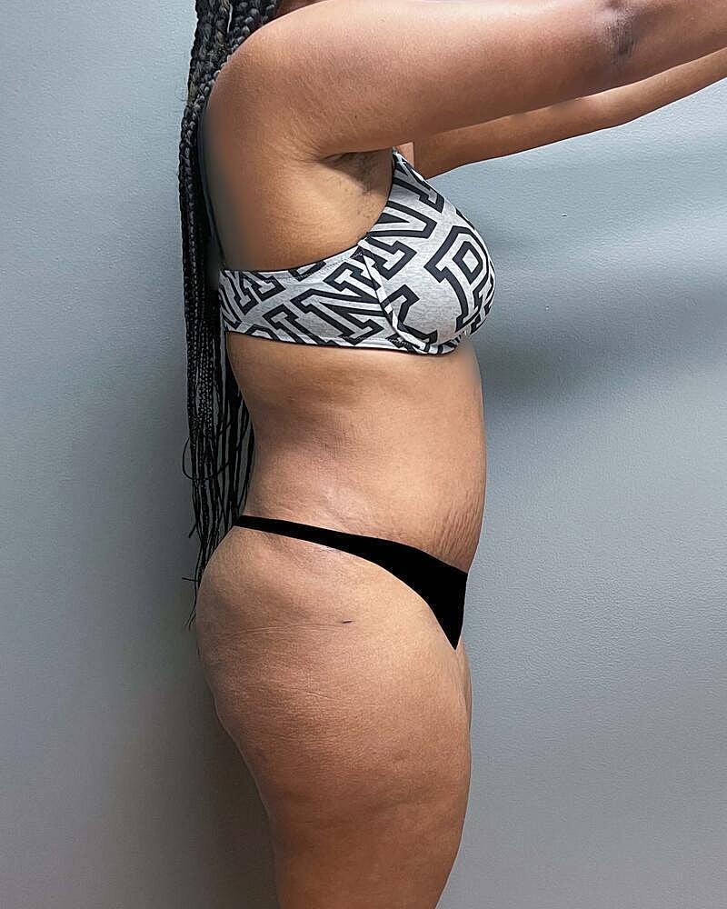 Tummy Tuck Before & After