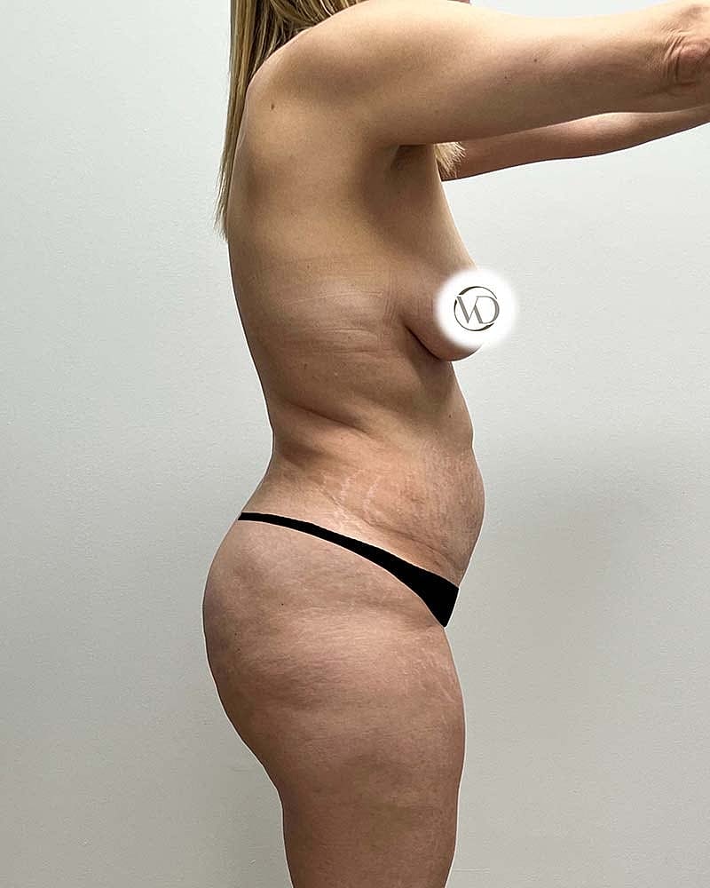 Tummy Tuck Before & After