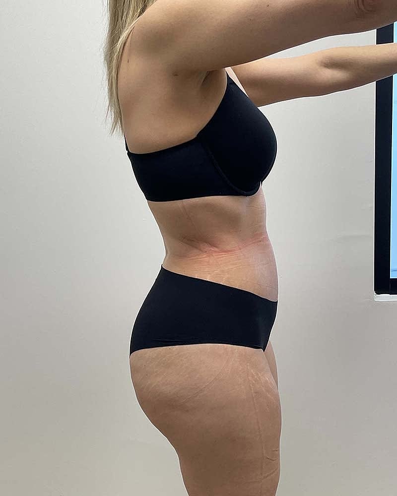 Tummy Tuck Before & After