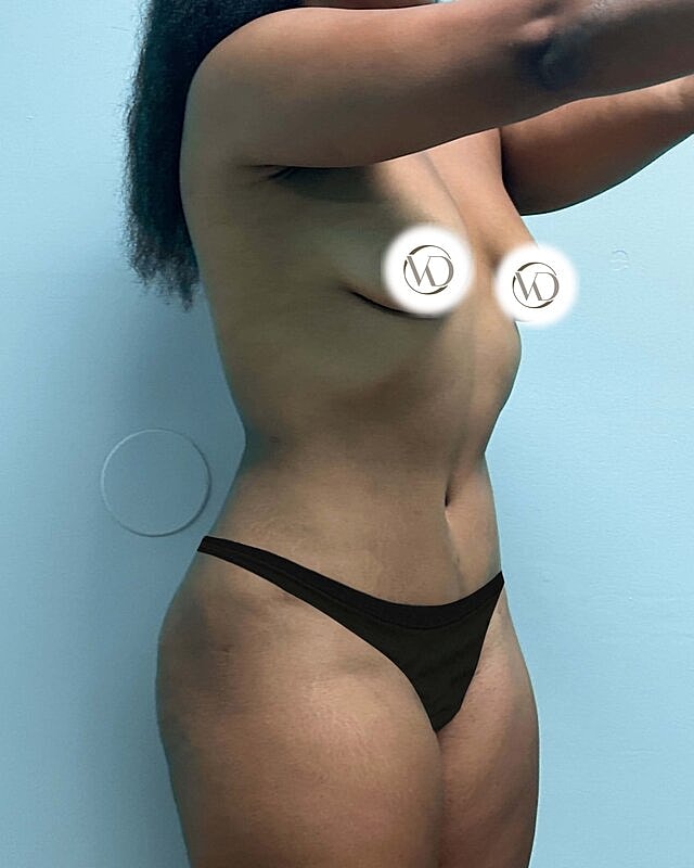 Tummy Tuck Before & After