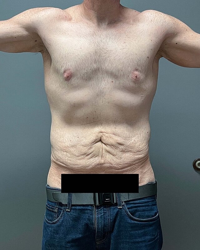 Tummy Tuck Before & After