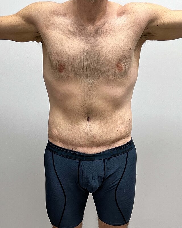 Tummy Tuck Before & After