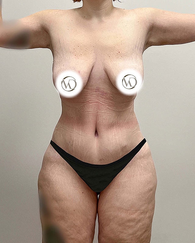 Tummy Tuck Before & After