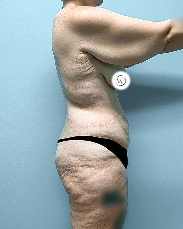 Tummy Tuck Before & After