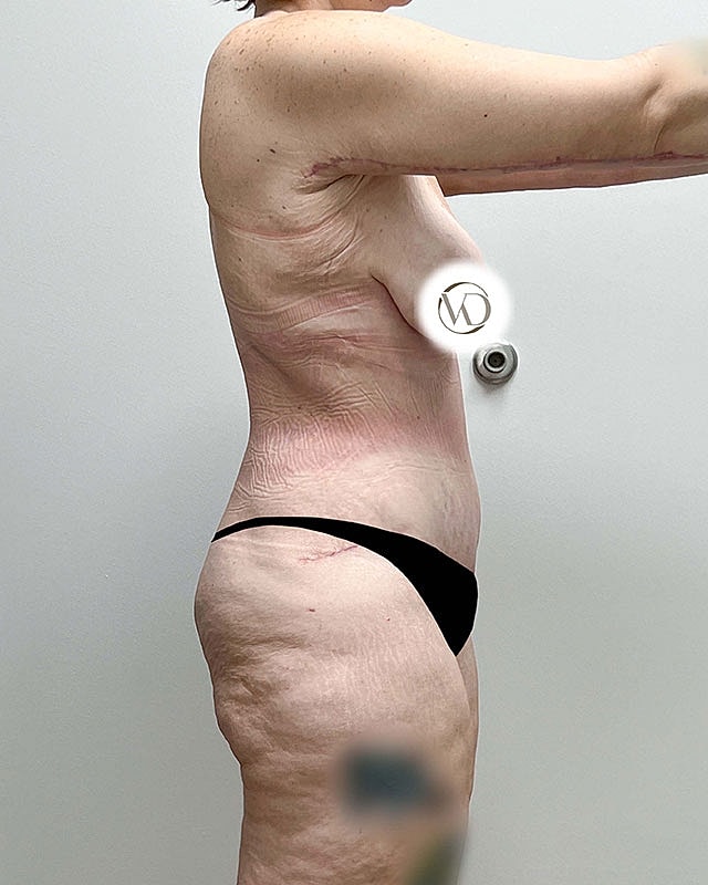 Tummy Tuck Before & After