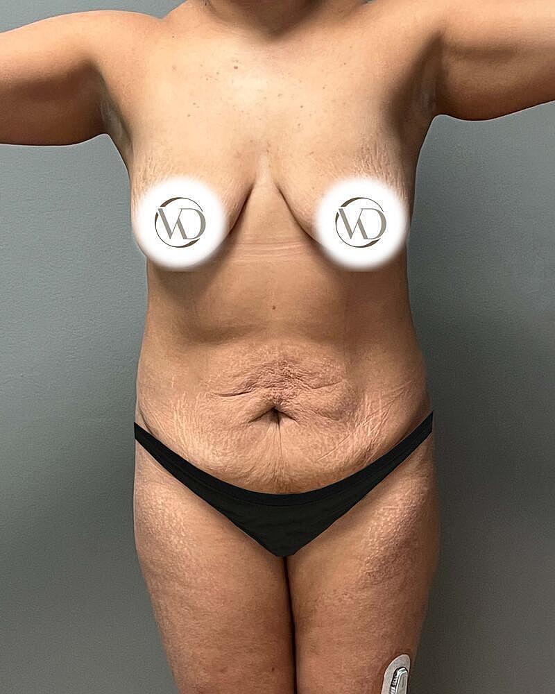 Tummy Tuck Before & After