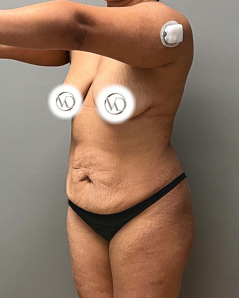 Tummy Tuck Before & After
