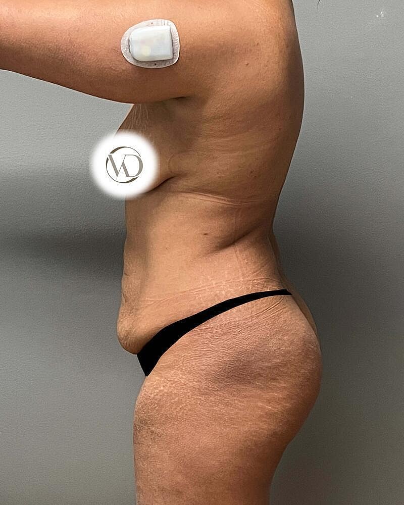 Tummy Tuck Before & After